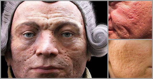 Natural Remedies For Pockmarks