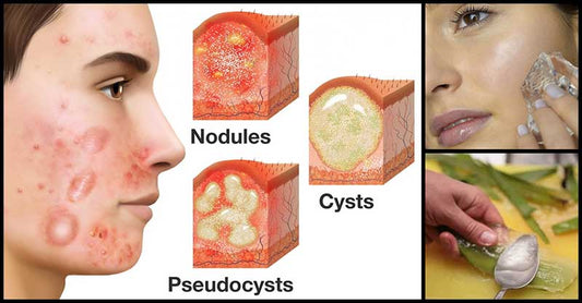 Effective Home Remedies Against Cystic Acne