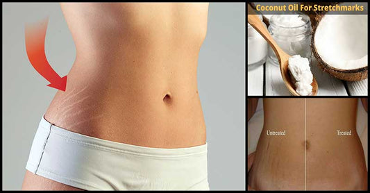 Different Ways To Remove Visible Stretch Marks Using Coconut Oil